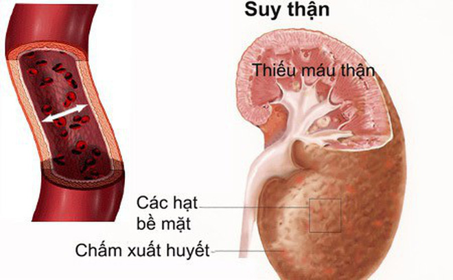 Suy thận cấp tính - Hình ảnh minh họa